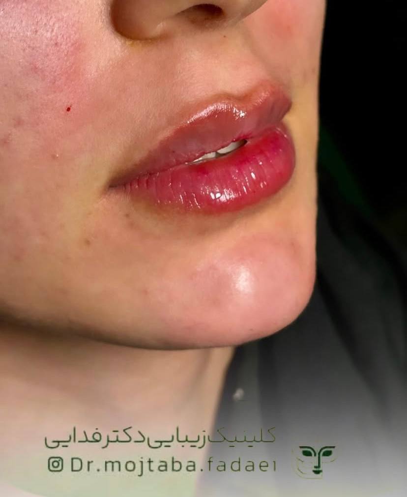 تزریق ژل لب در اصفهان