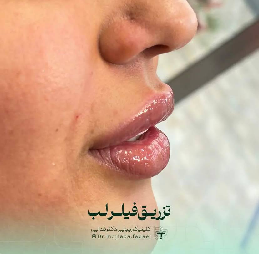 تزریق فیلر در اصفهان