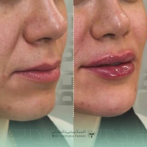 تزریق ژل در اصفهان