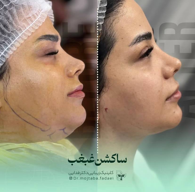 ساکشن غبغب در اصفهان