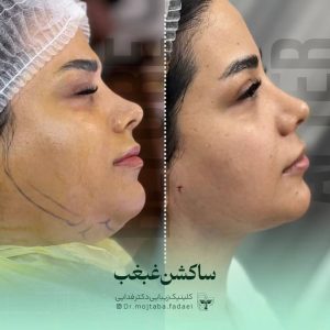 ساکشن غبغب