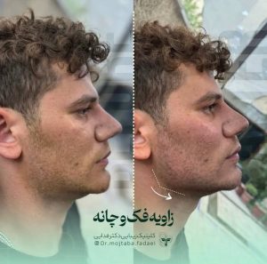 ساکشن غبغب در اصفهان