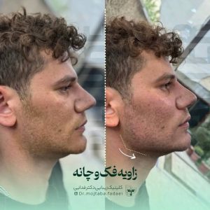 تغیرات زاویه فک و چانه