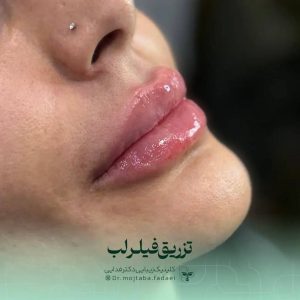 فیلر لب